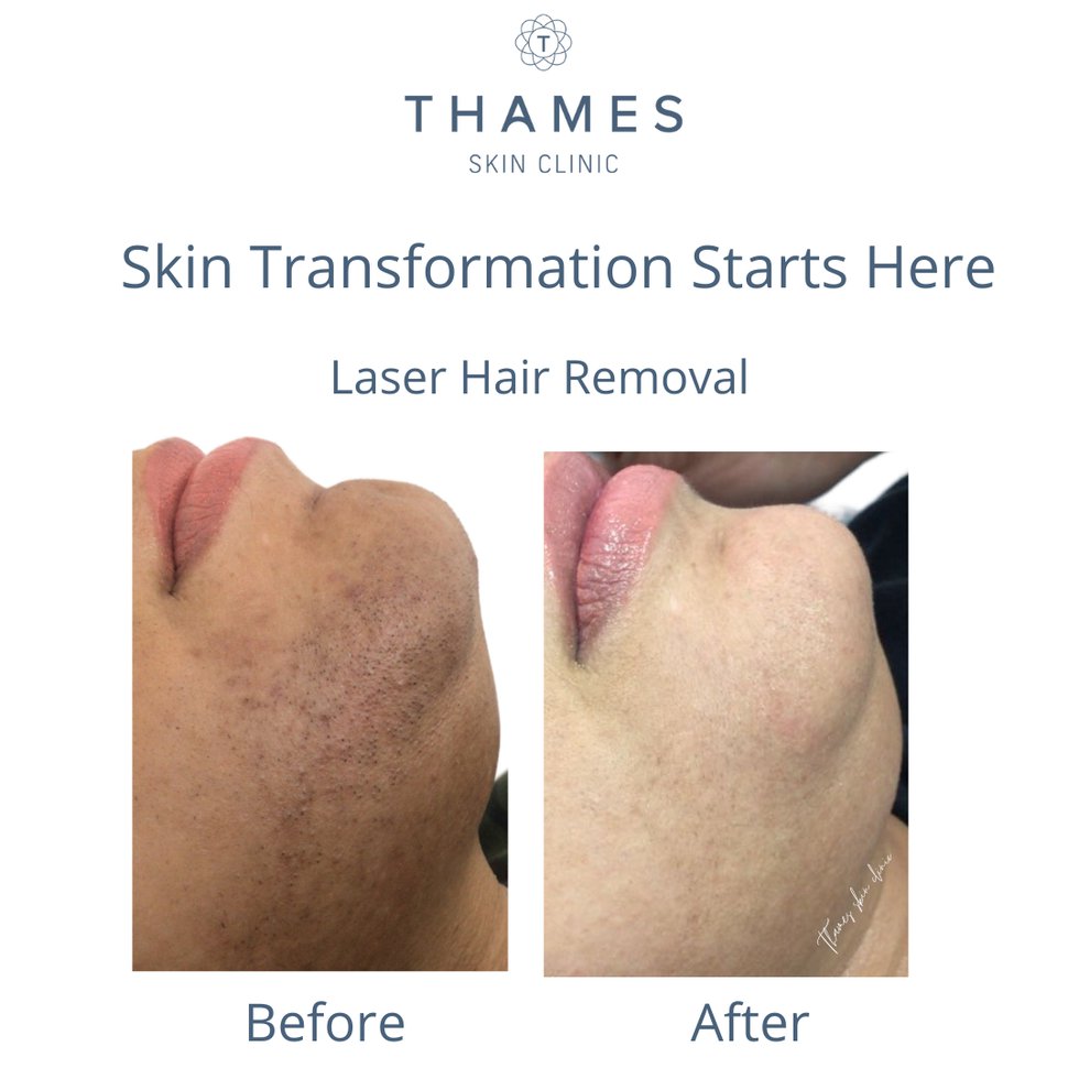 Laser hair removal B&amp;A - 1
