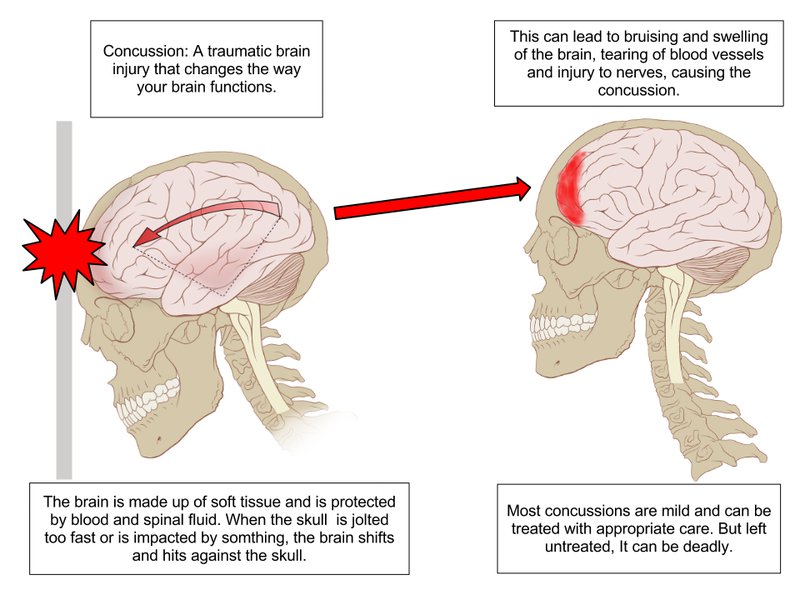 concussion diagram.jpg